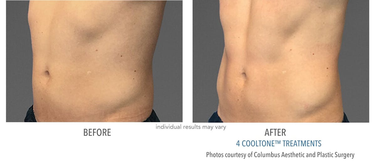Cooltone Before & After Gallery - Patient 310665 - Image 1
