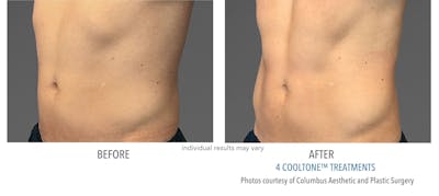 Cooltone Before & After Gallery - Patient 310665 - Image 1