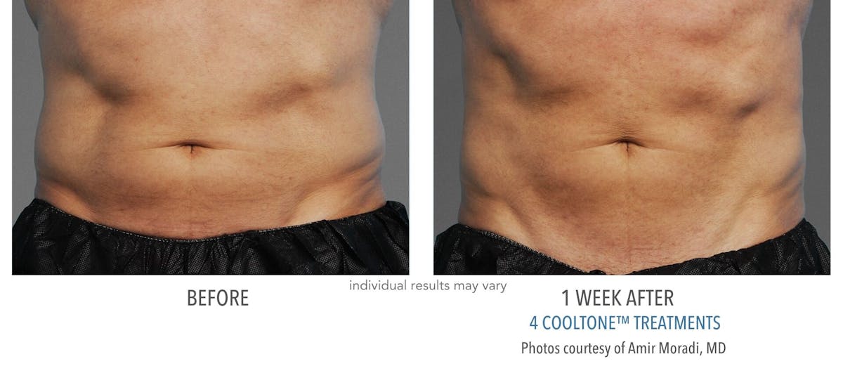 Cooltone Before & After Gallery - Patient 223832 - Image 1