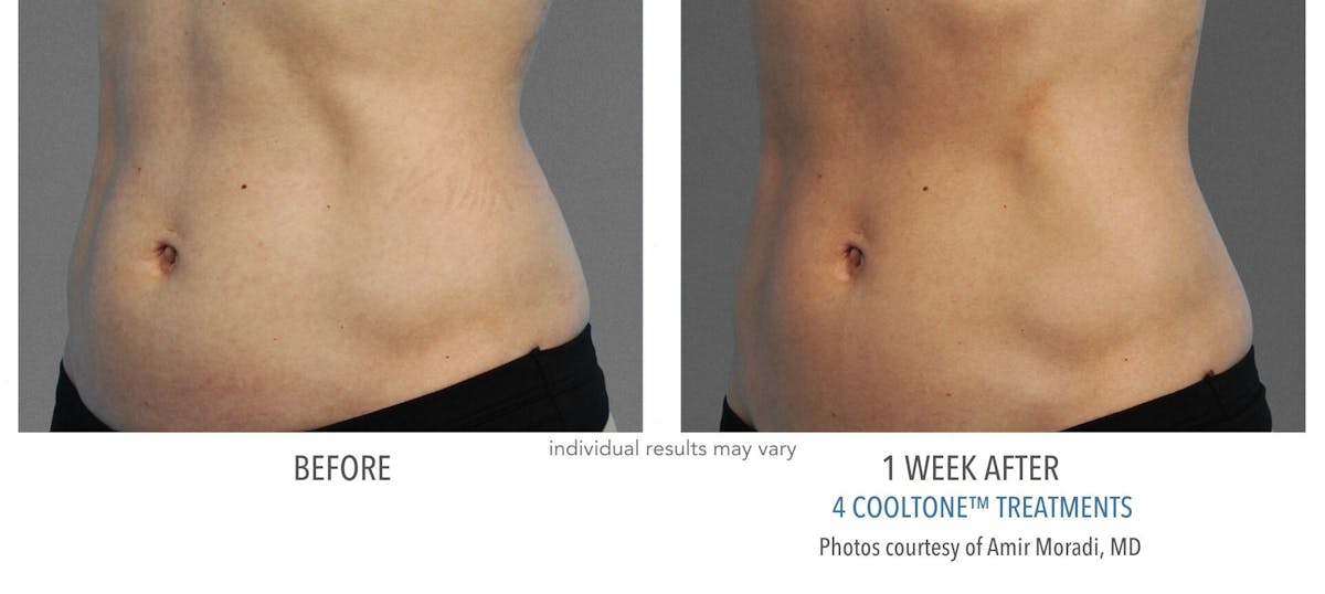 Cooltone Before & After Gallery - Patient 159397 - Image 1