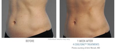 Cooltone Before & After Gallery - Patient 159397 - Image 1
