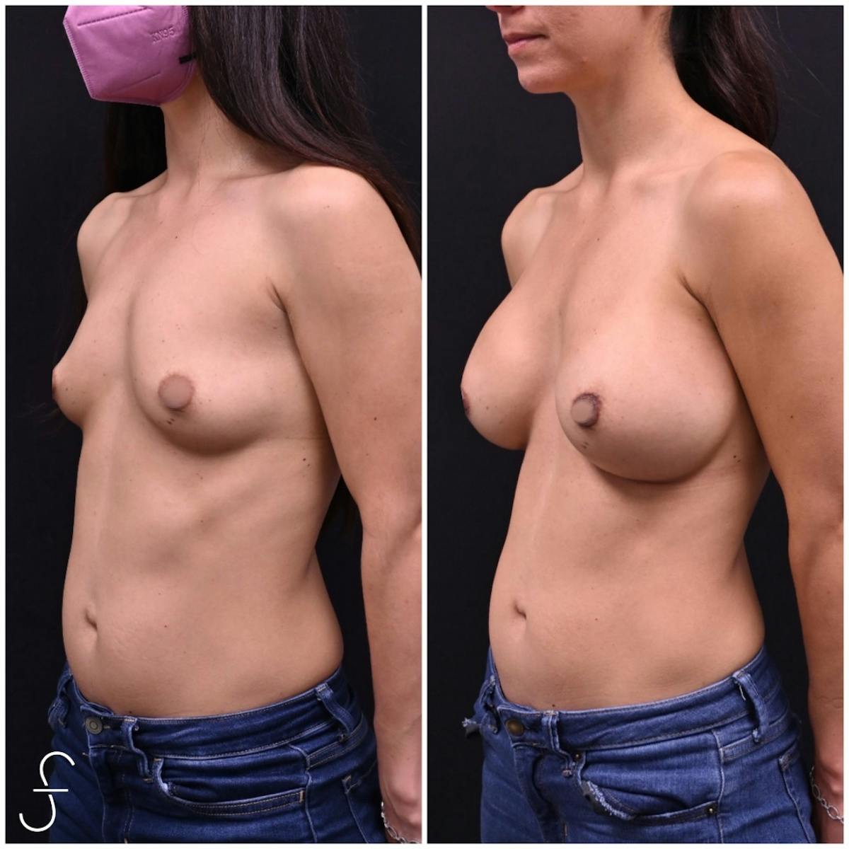 Breast Augmentation Before & After Gallery - Patient 272234 - Image 1