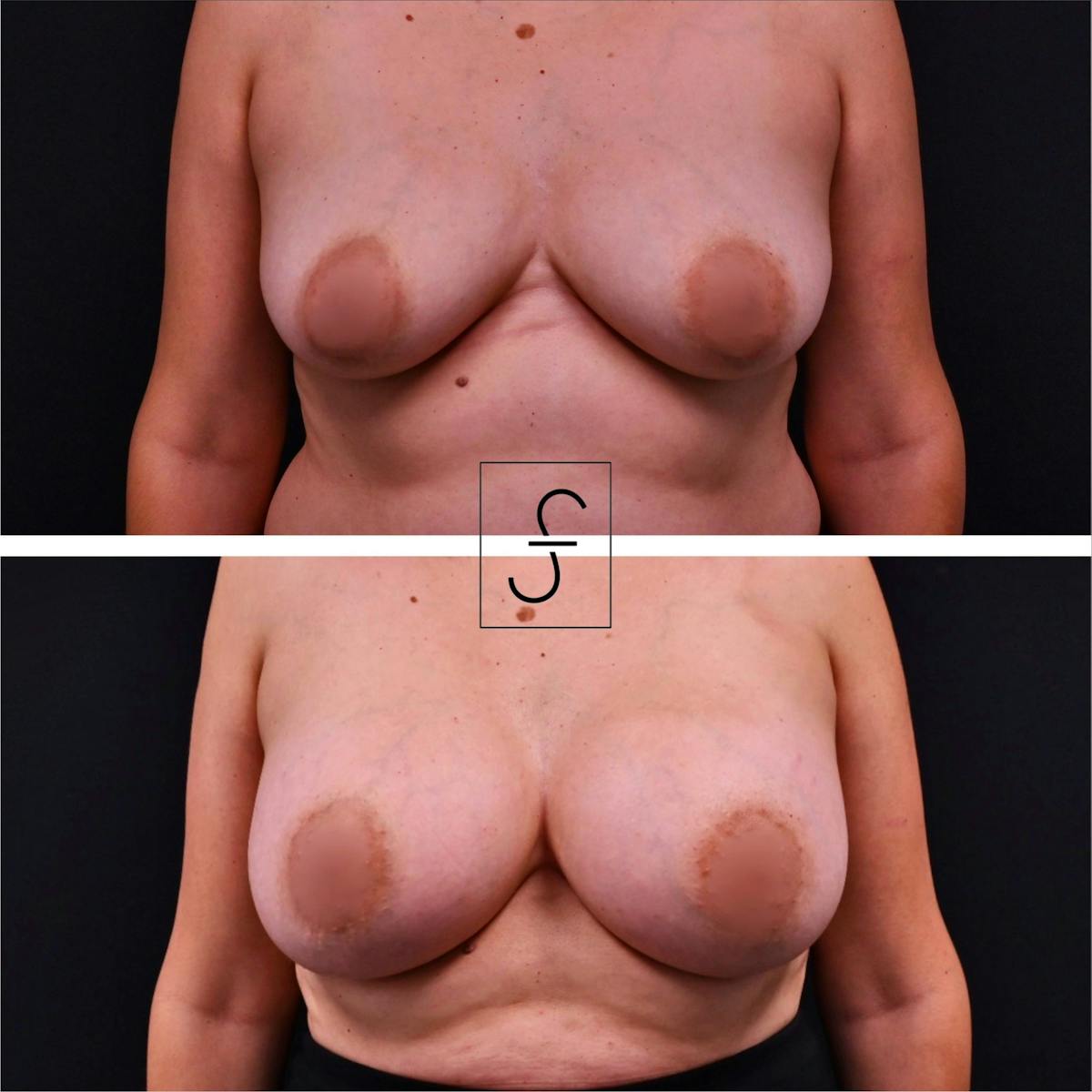 Breast Augmentation Before & After Gallery - Patient 373726 - Image 1