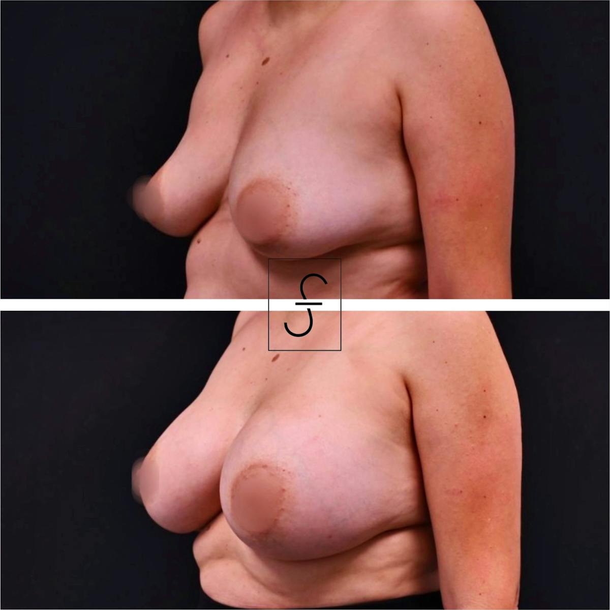 Breast Augmentation Before & After Gallery - Patient 373726 - Image 2