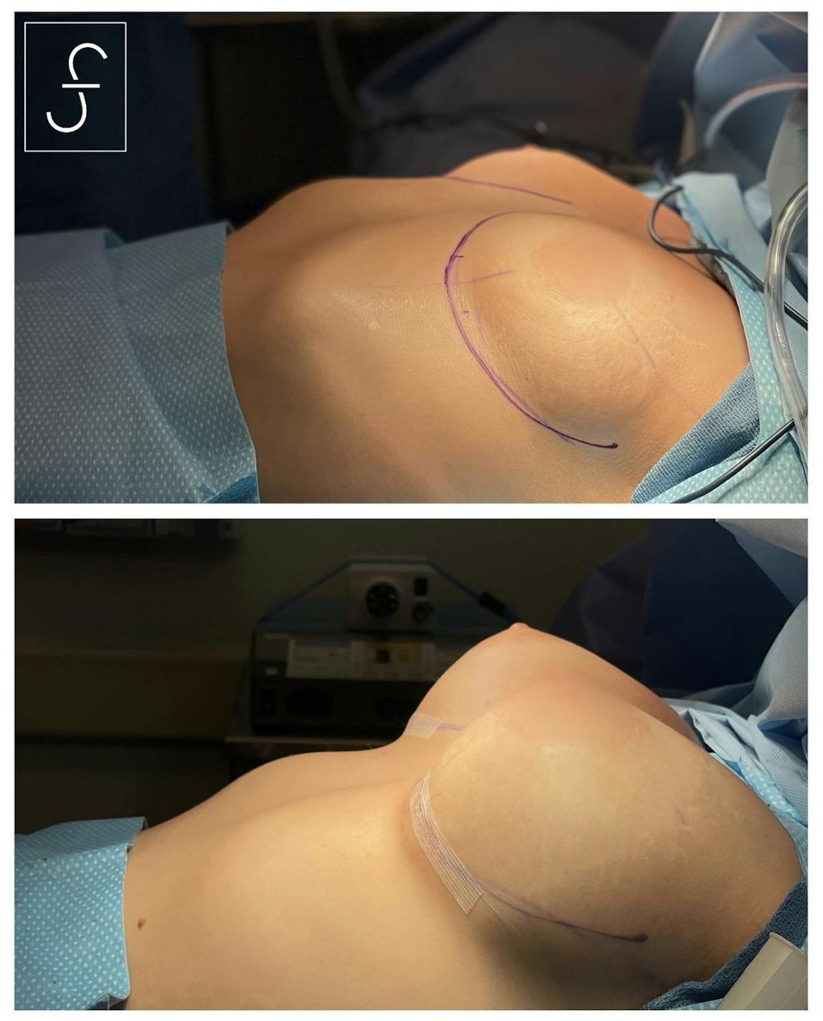 Breast Augmentation Before & After Gallery - Patient 129222 - Image 1