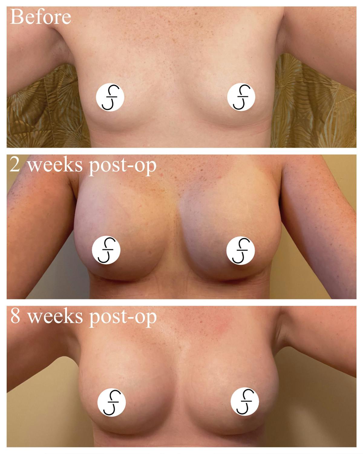 Breast Augmentation Before & After Gallery - Patient 280831 - Image 1