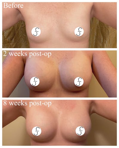 Breast Augmentation Before & After Gallery - Patient 280831 - Image 1