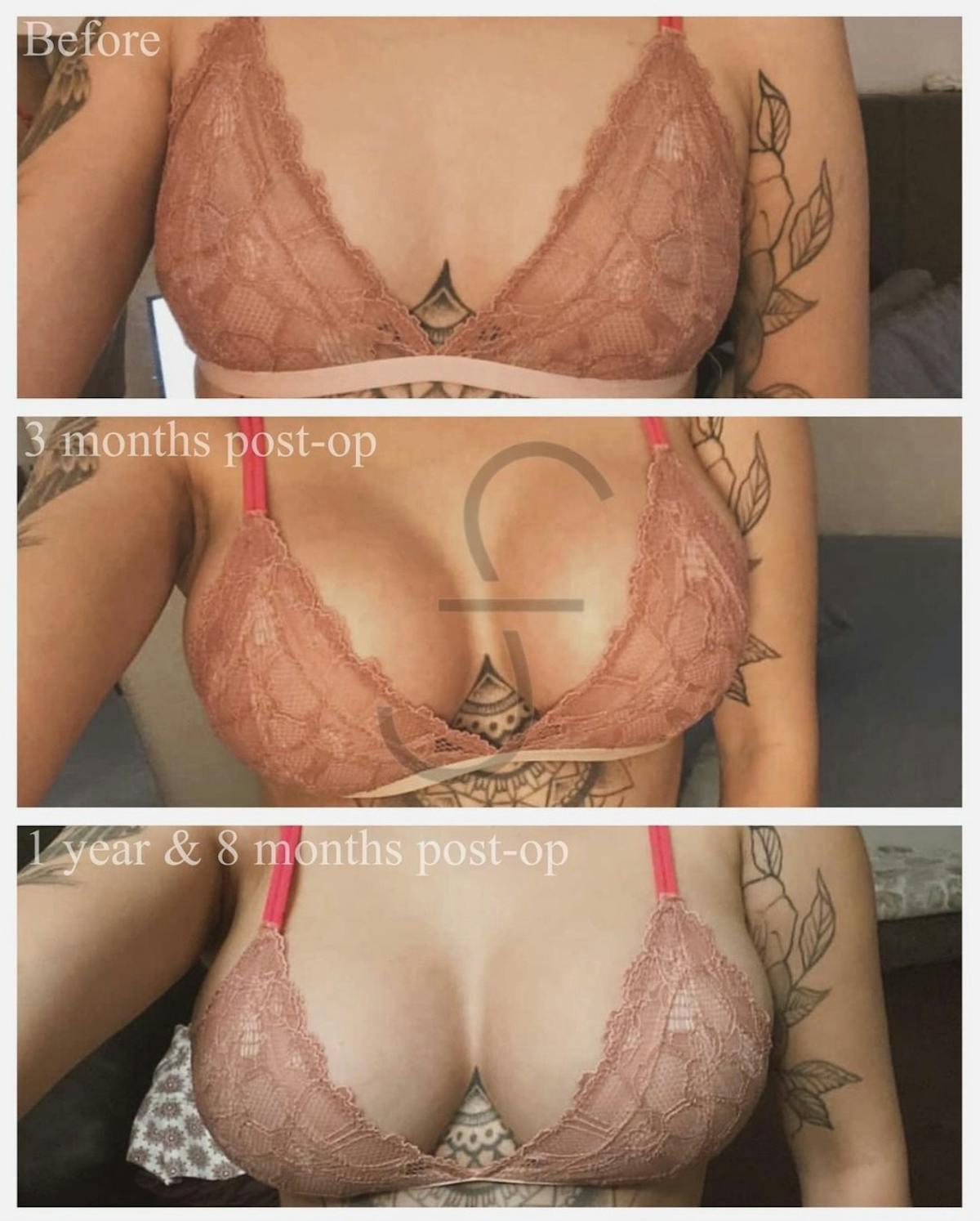Breast Augmentation Before & After Gallery - Patient 214966 - Image 1