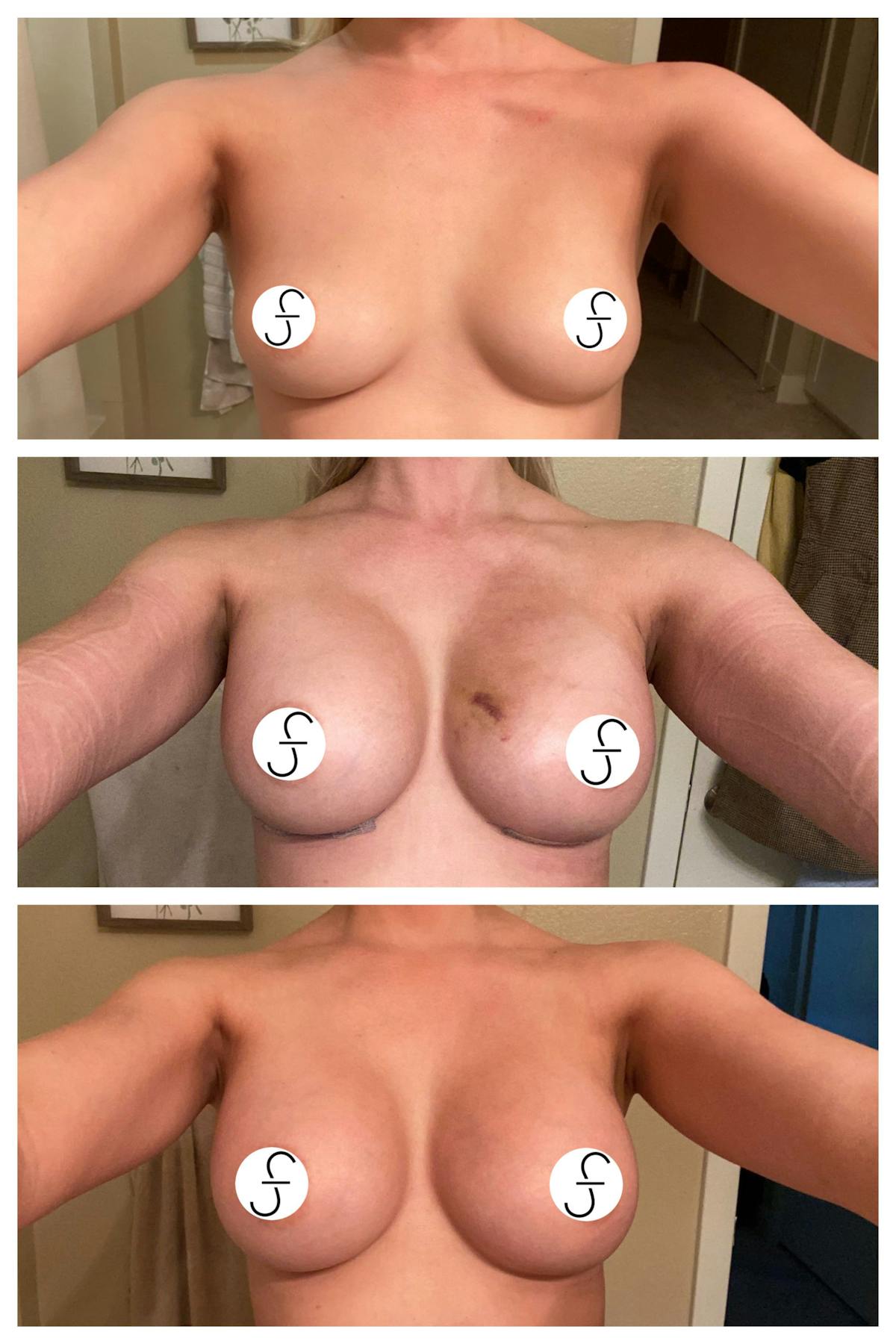 Breast Augmentation Before & After Gallery - Patient 560673 - Image 1