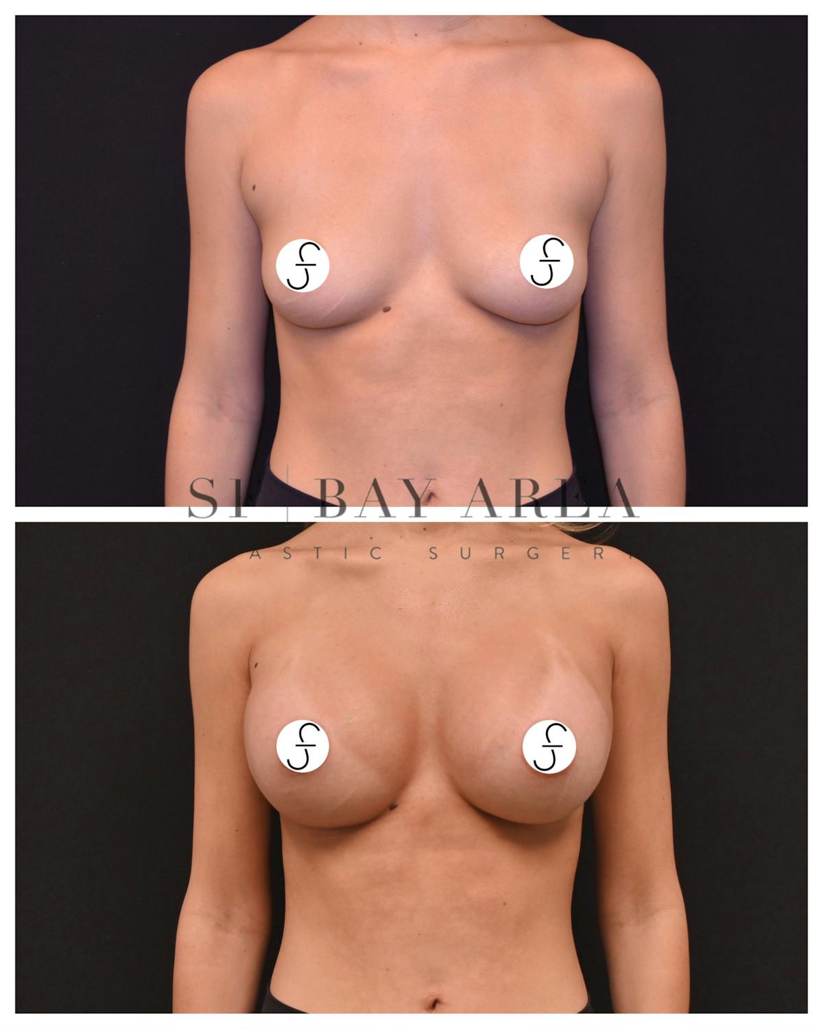 Breast Augmentation Before & After Gallery - Patient 267229 - Image 1