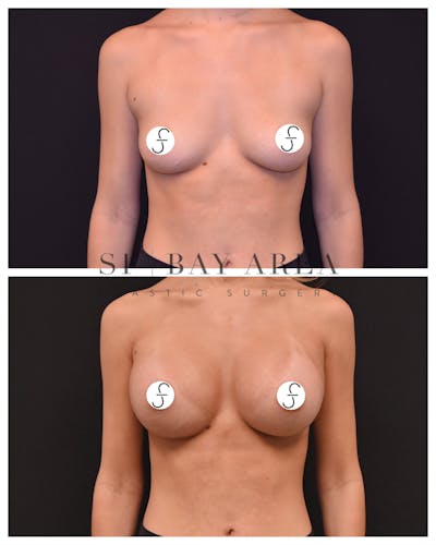Breast Augmentation Before & After Gallery - Patient 267229 - Image 1