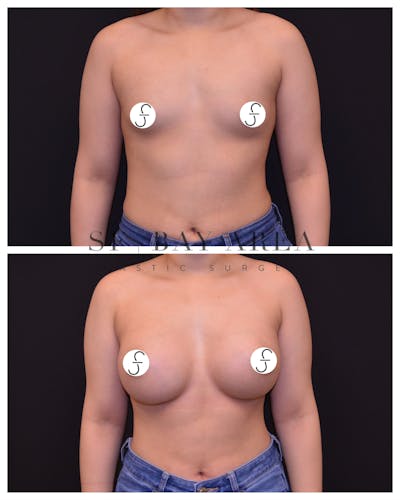 Breast Augmentation Before & After Gallery - Patient 137998 - Image 1