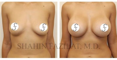 Breast Augmentation Before & After Gallery - Patient 287063 - Image 1