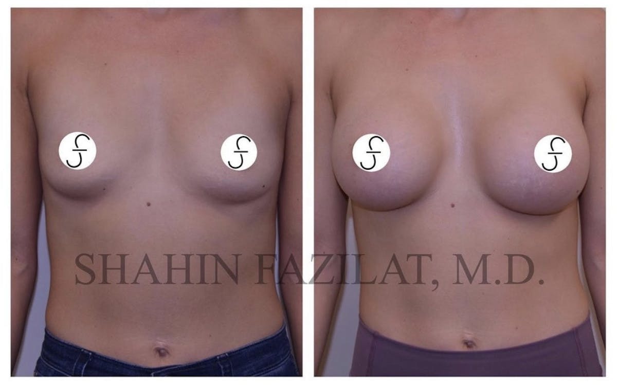 Breast Augmentation Before & After Gallery - Patient 263865 - Image 1