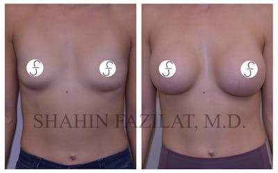 Breast Augmentation Before & After Gallery - Patient 263865 - Image 1