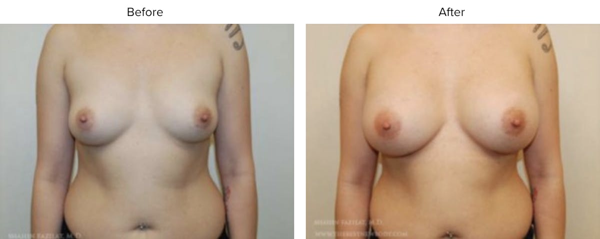 Breast Augmentation Before & After Gallery - Patient 425597 - Image 1