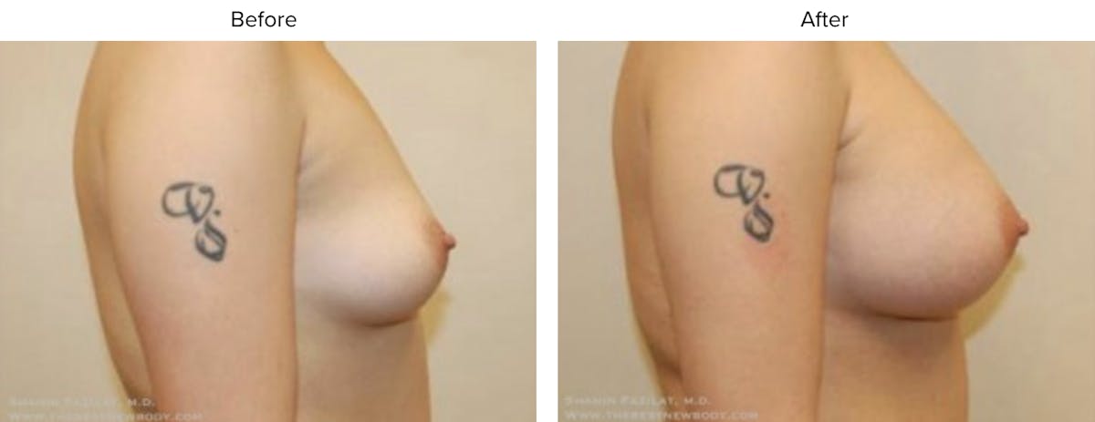 Breast Augmentation Before & After Gallery - Patient 303965 - Image 1