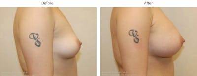 Breast Augmentation Before & After Gallery - Patient 303965 - Image 1