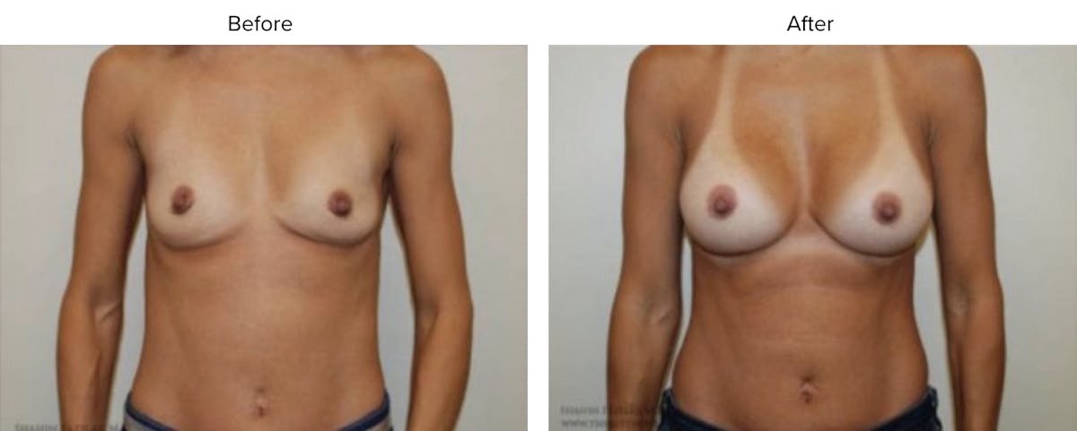 Breast Augmentation Before & After Gallery - Patient 341136 - Image 1