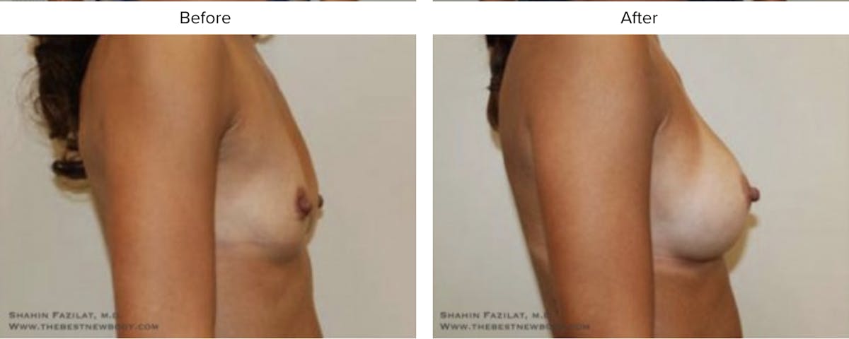 Breast Augmentation Before & After Gallery - Patient 341136 - Image 2
