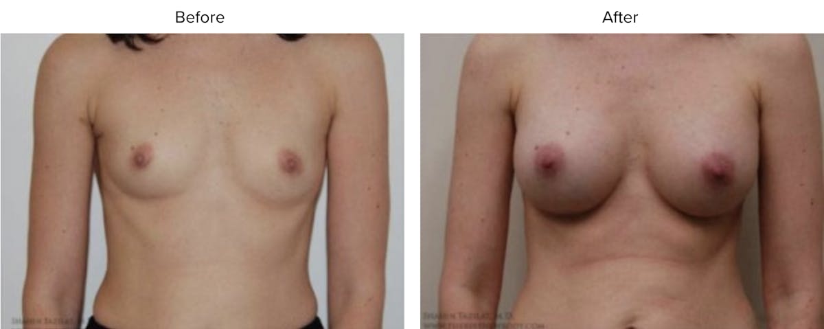 Breast Augmentation Before & After Gallery - Patient 107215 - Image 1