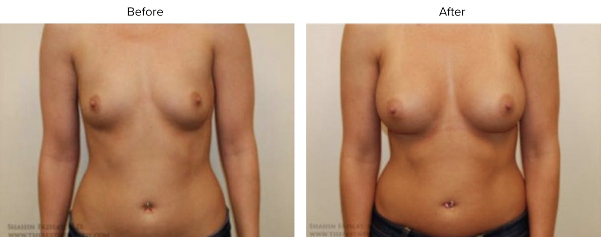 Breast Augmentation Before & After Gallery - Patient 138367 - Image 1