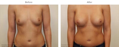 Breast Augmentation Before & After Gallery - Patient 138367 - Image 1