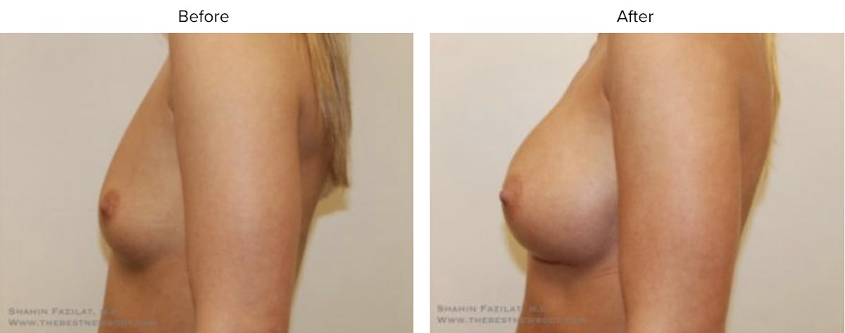 Breast Augmentation Before & After Gallery - Patient 356868 - Image 1