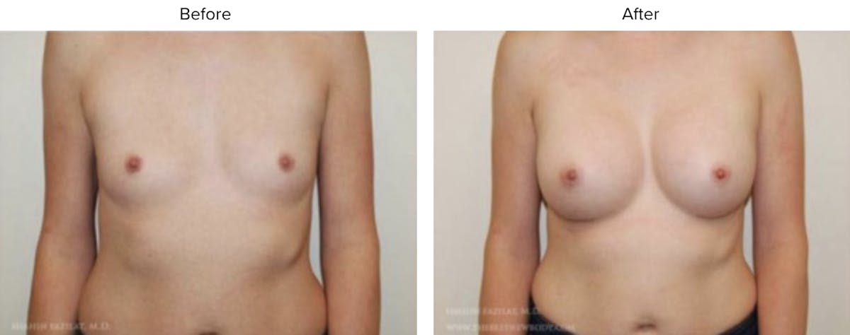 Breast Augmentation Before & After Gallery - Patient 153322 - Image 1