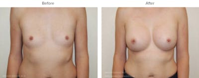 Breast Augmentation Before & After Gallery - Patient 153322 - Image 1