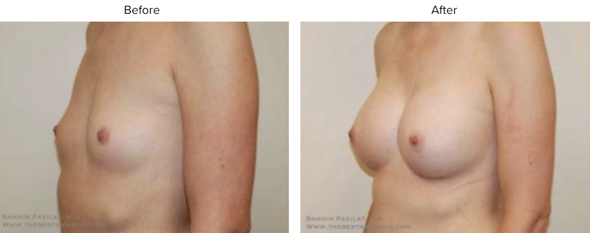 Breast Augmentation Before & After Gallery - Patient 107215 - Image 2