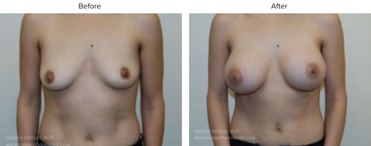 Breast Augmentation Before & After Gallery - Patient 304594 - Image 1