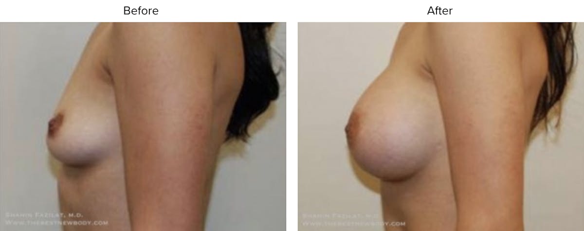 Breast Augmentation Before & After Gallery - Patient 224107 - Image 1