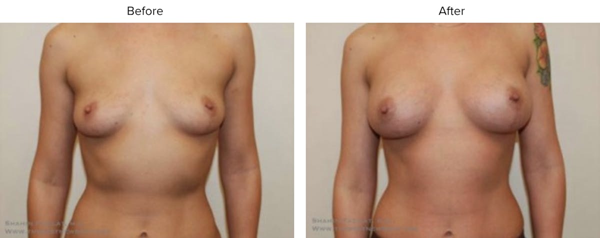 Breast Augmentation Before & After Gallery - Patient 289459 - Image 1
