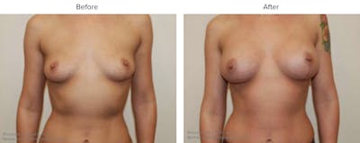 Breast Augmentation Before & After Gallery - Patient 289459 - Image 1
