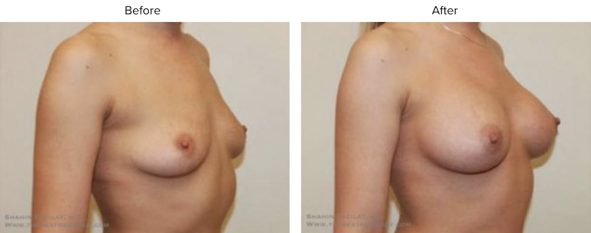 Breast Augmentation Before & After Gallery - Patient 289459 - Image 2