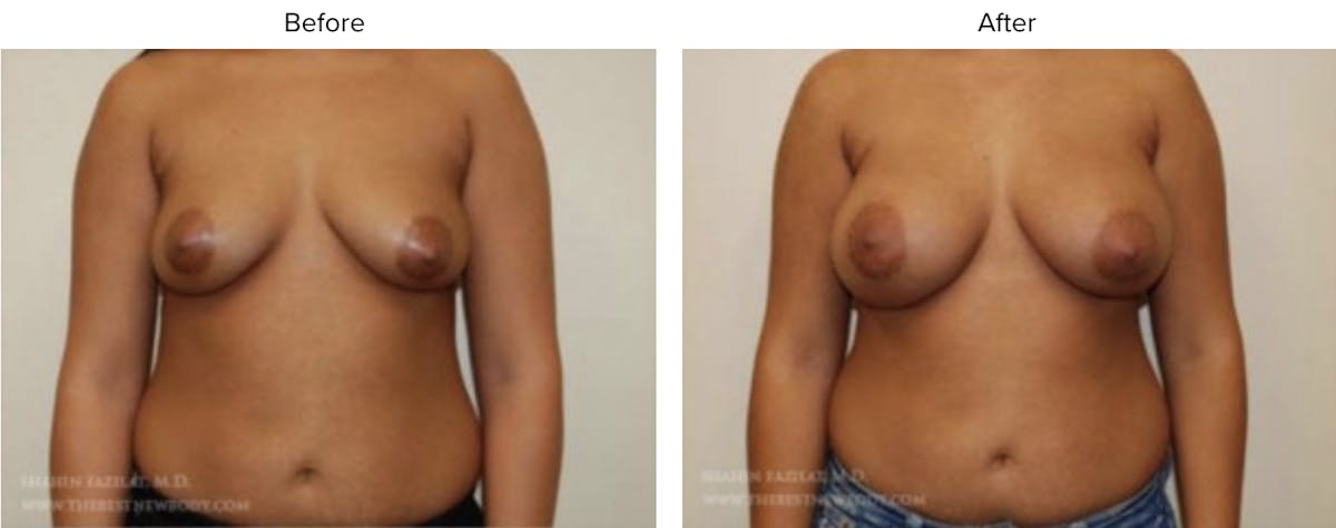 Breast Augmentation Before & After Gallery - Patient 239763 - Image 1