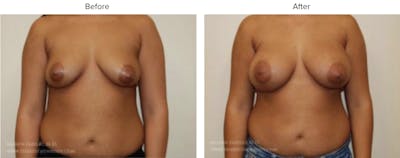 Breast Augmentation Before & After Gallery - Patient 239763 - Image 1