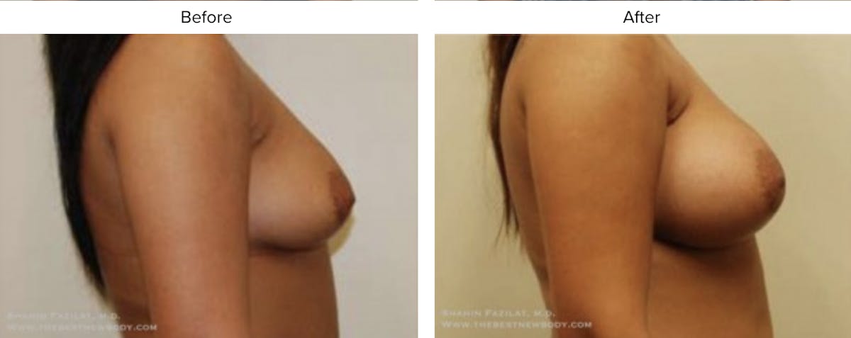 Breast Augmentation Before & After Gallery - Patient 239763 - Image 2