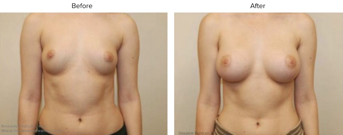 Breast Augmentation Before & After Gallery - Patient 269957 - Image 1