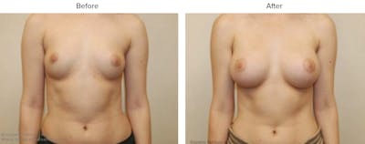 Breast Augmentation Before & After Gallery - Patient 269957 - Image 1