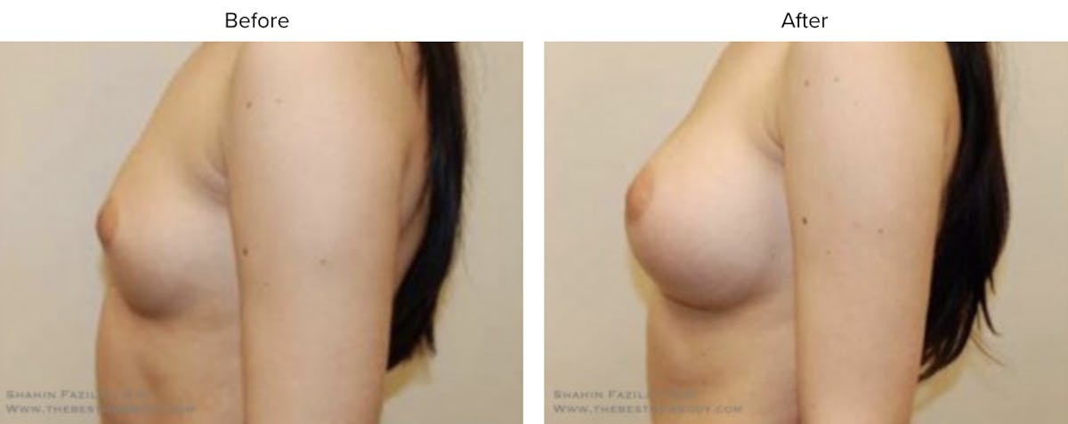 Breast Augmentation Before & After Gallery - Patient 269957 - Image 2