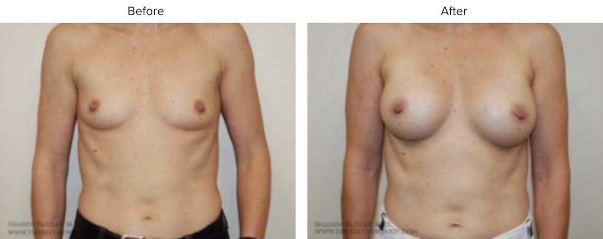 Breast Augmentation Before & After Gallery - Patient 325027 - Image 1