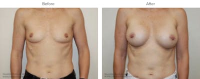 Breast Augmentation Before & After Gallery - Patient 325027 - Image 1
