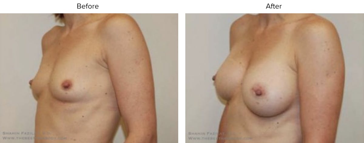 Breast Augmentation Before & After Gallery - Patient 325027 - Image 2