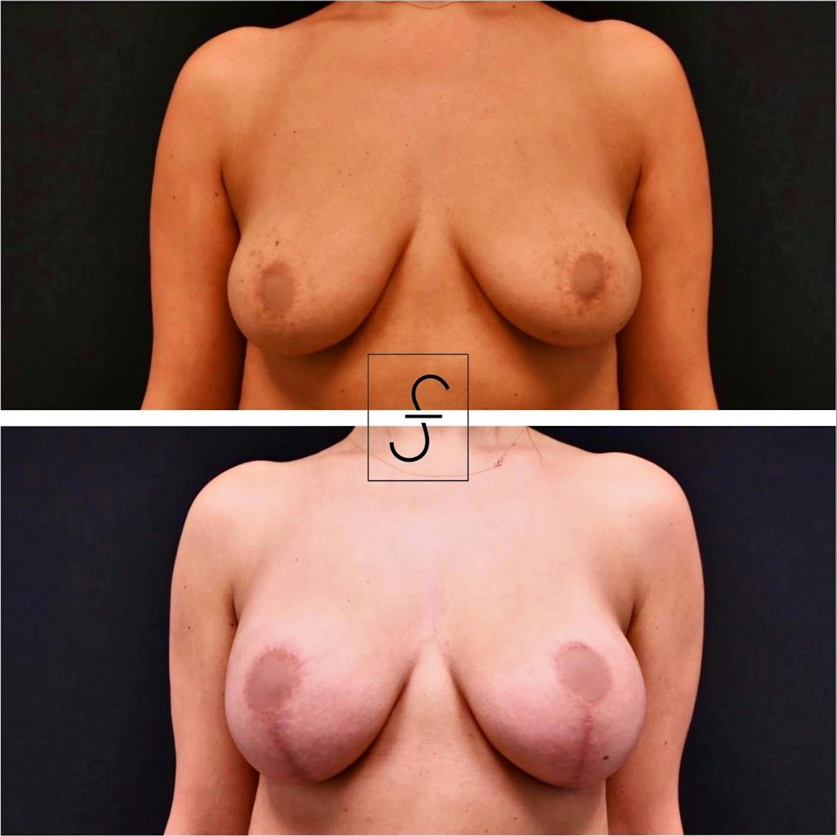 Breast Augmentation with Lift Before & After Gallery - Patient 116438 - Image 1