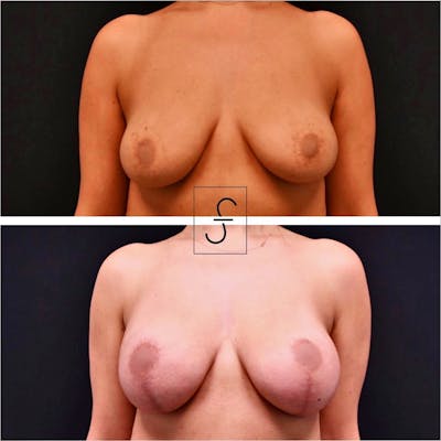 Breast Augmentation with Lift Before & After Gallery - Patient 116438 - Image 1