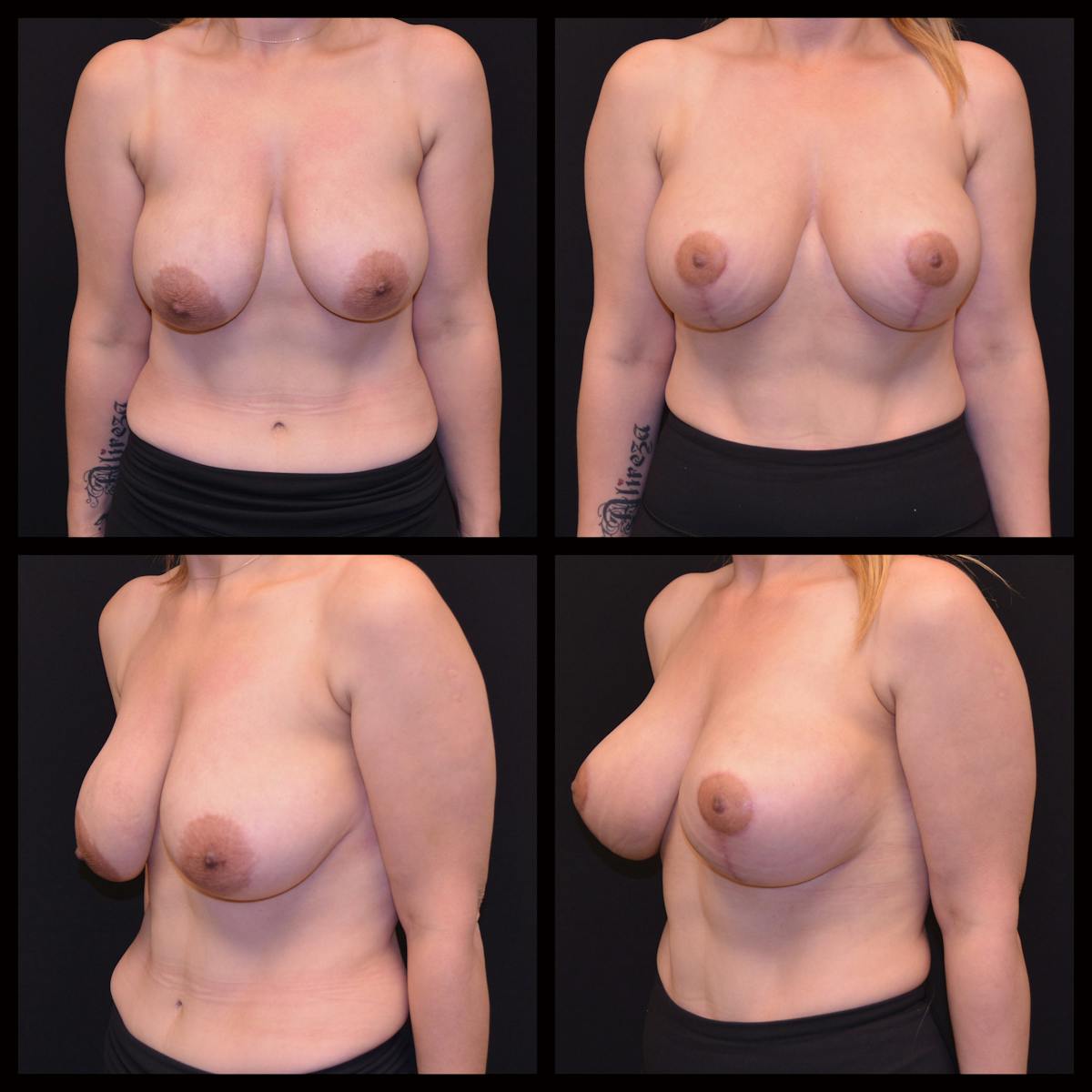Breast Augmentation with Lift Before & After Gallery - Patient 965474 - Image 1
