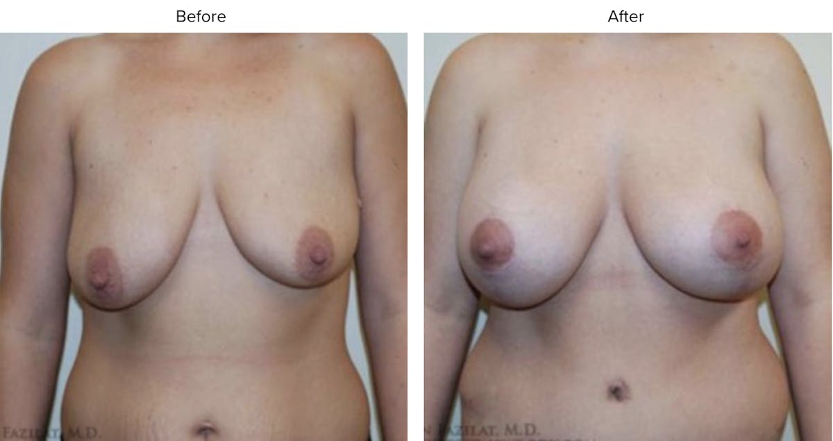 Breast Augmentation with Lift Before & After Gallery - Patient 187915 - Image 1