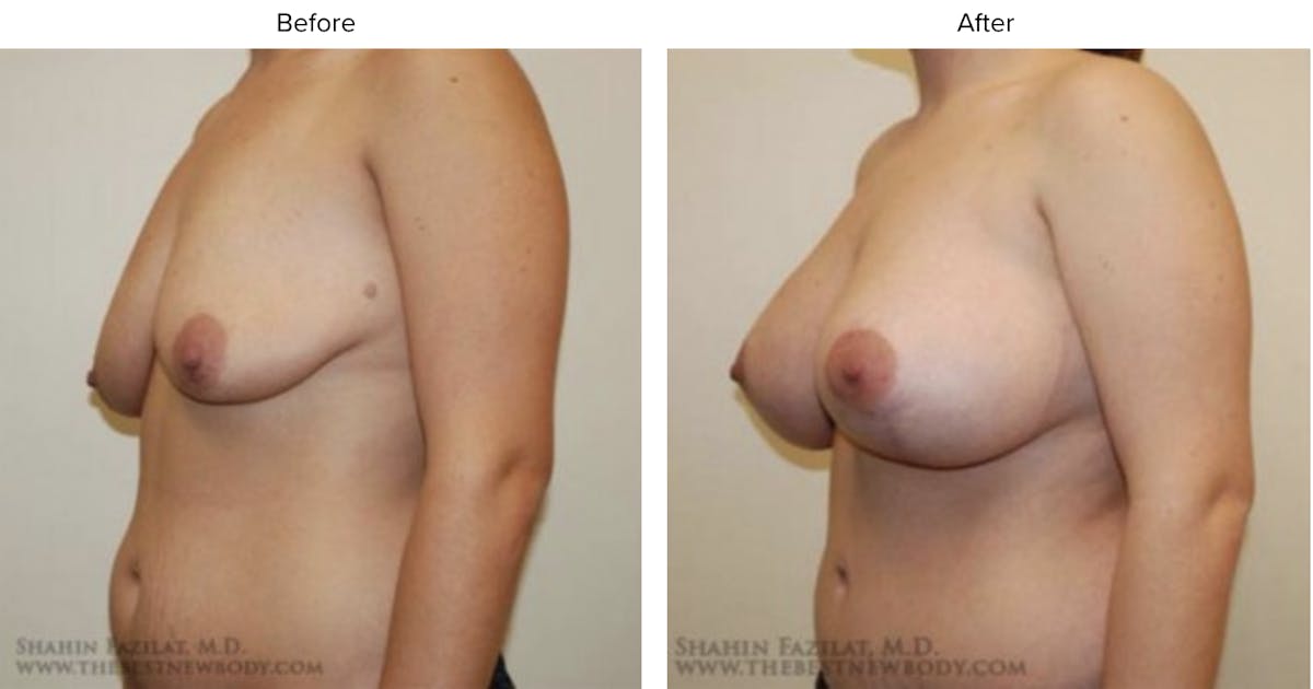 Breast Augmentation with Lift Before & After Gallery - Patient 199069 - Image 1